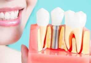 Smiling woman with tooth implant model