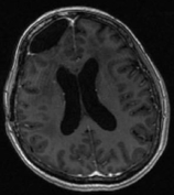 Ressonância após a cirurgia com remoção total do tumor e paciente sem epilepsia.
