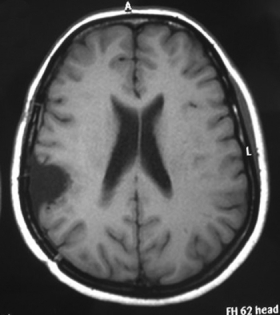 Ressonância magnética após a cirurgia mostrando a retirada total do meningeoma.