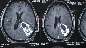 Motor strip glioma resected with cortical mapping and navigation control