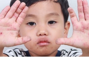 infeksi kulit pada anak