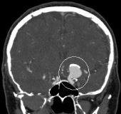 Angiotomografia projeção frontal demonstrando a presença de um volumoso aneurisma cerebral.