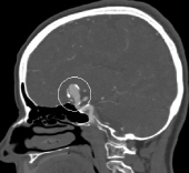 Angiotomografia projeção perfil. O círculo indica o volumoso aneurisma cerebral.