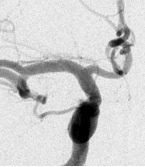Angiografia digital projeção frontal após a cirurgia no cérebro e clipagem do aneurisma cerebral.