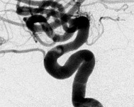 Angiografia digital projeção perfil após a cirurgia no cérebro e clipagem do aneurisma cerebral.