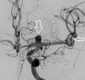 Angiografia digital projeção frontal. A seta indica o aneurisma cerebral.