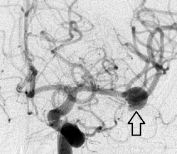 Angiografia digital projeção frontal. A seta indica o aneurisma cerebral.