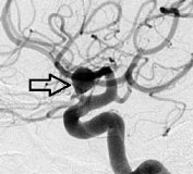 Angiografia digital projeção perfil. A seta indica o aneurisma cerebral.