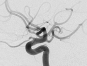 Angiografia digital projeção perfil após a cirurgia no cérebro e clipagem do aneurisma cerebral.
