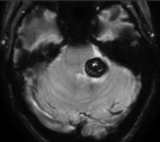 Paciente com cavernoma e sangramento intracerebral antes de cirurgia no cérebro.