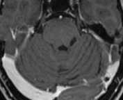 Ressonância após a cirurgia com remoção do cavernoma e sem risco de novo sangramento.