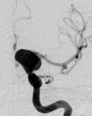 Angiografia digital projeção frontal mostrando um volumoso aneurisma cerebral.