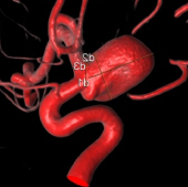 Angiografia digital 3D perfil mostrando o mesmo aneurisma cerebral.
