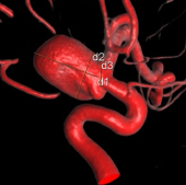 Angiografia digital 3D mostrando a face lateral do aneurisma cerebral.