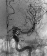 Angiografia após a cirurgia no cérebro e clipagem do aneurisma cerebral.