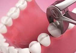 a dental model with extraction of a tooth