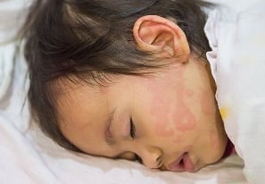 Kulit kemerahan pada anak