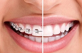 before and after view of a woman with braces 
