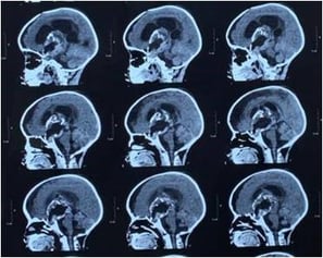 CT Scan After Surgery