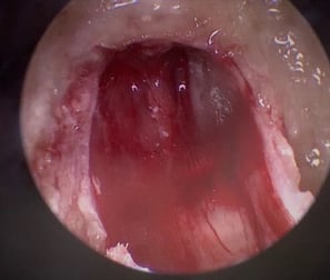 Complete tumour removal with intact facial nerve