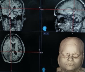 Intra-operative cortical stimulation