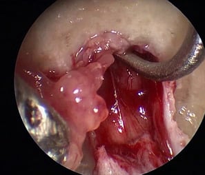 USE OF ENDOSCOPE DURING SURGERY