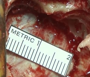 Micro Craniotomy