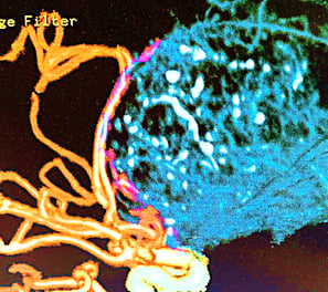 ARTERIAL DISPLACEMENT