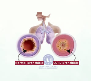 COPD