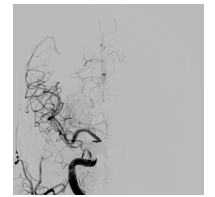 Blocking of the fistula with coils