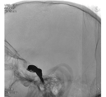 Blocking of the fistula with coils