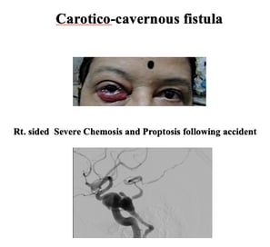 Fistula or abnormal communication