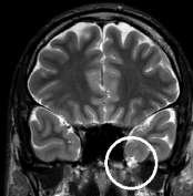 Ressonância de homem de 30 anos com epilepsia desde os 17 anos. Círculo indica encefalocele.