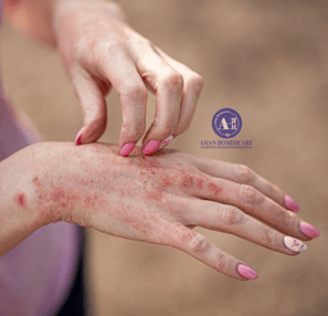 Contact Dermatitis Homeopathic Treatment