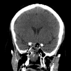 Post-operative CT scan. Complete tumour removal