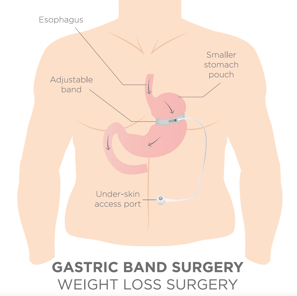 gastric band