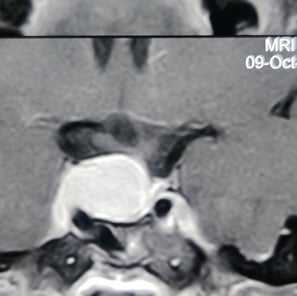 pituitary tumour