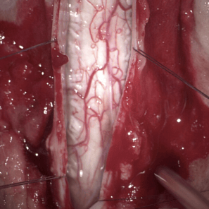 Tumour inside the spinal cord