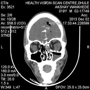 CT cisternography showing site of CSF leak into the nose