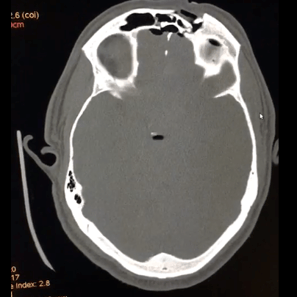 Fracture of frontal air sinus