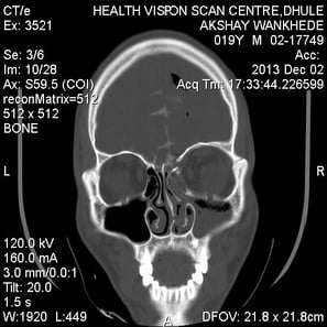 Fracture of skull base bone