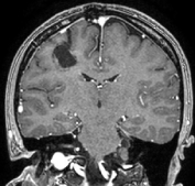 Ressonância após a cirurgia com a remoção total do cavernoma.