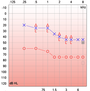 A puretone audiogram showing bilateral hearing loss