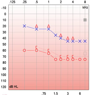 A puretone audiogram showing bilateral asymmetrical loss