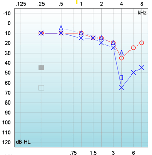 A typical pure tone audiogram for noise induced hearing loss from shooting