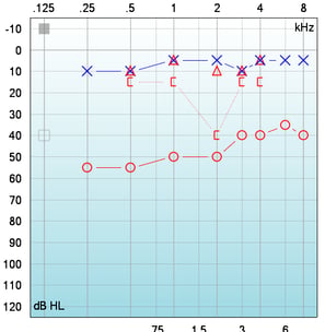 A typical puretone audiogram for otosclerosis