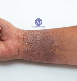 Atopic dermatitis (Eczema) Homeopathic treatment