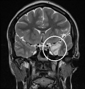 Ressonância de menina de 13 anos com epilepsia há 3 anos com tumor cerebral.