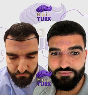 Before & after DHI hair transplant at HairTurk: bald man to full hair, smiling