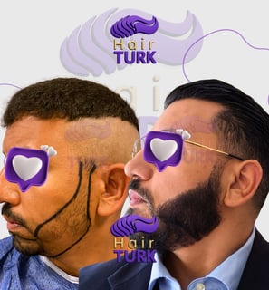 Before & after beard transplant at HairTurk: bald man to full beard man, smiling.